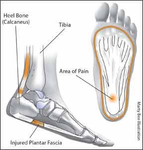 Heel Pain: Rx for Underfoot Agony - Arthritis Advisor