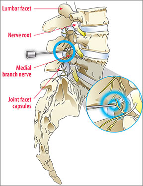 Burning Away Back Pain with Radiofrequency Ablation - Arthritis Advisor