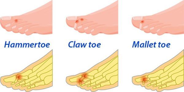 toe-deformities-what-you-should-know-arthritis-advisor