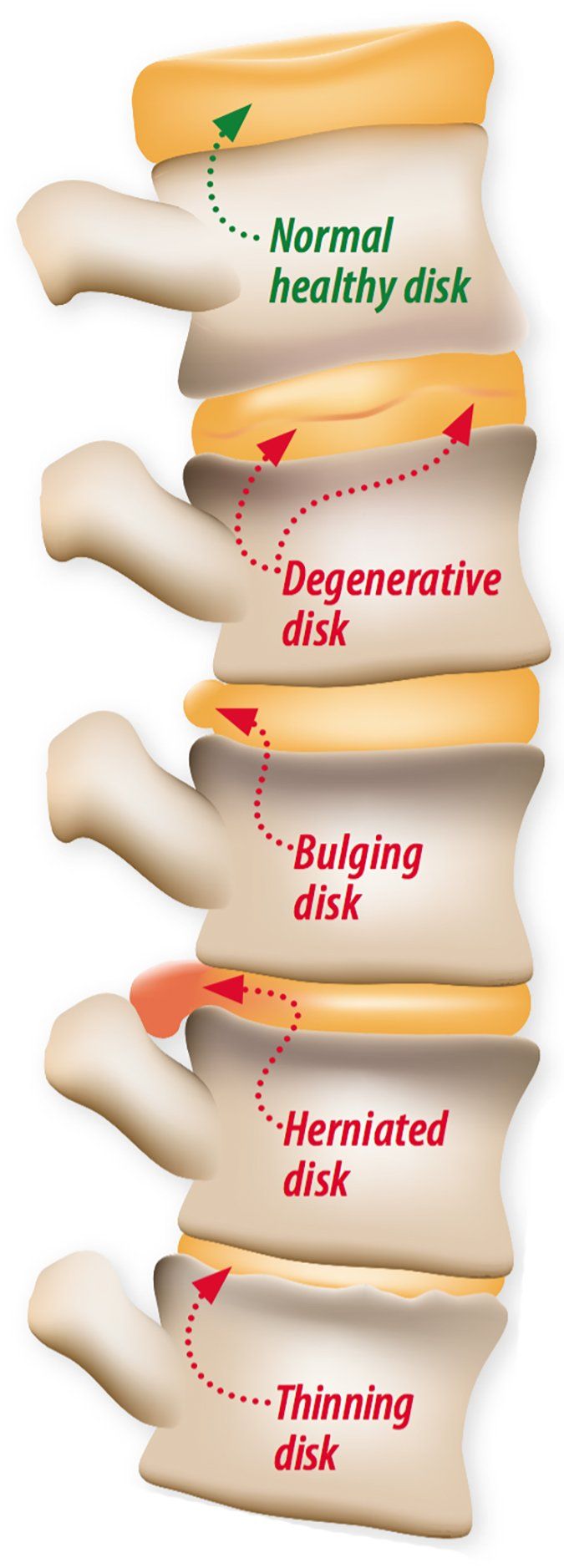 Phases Of Degenerative Disc Disease