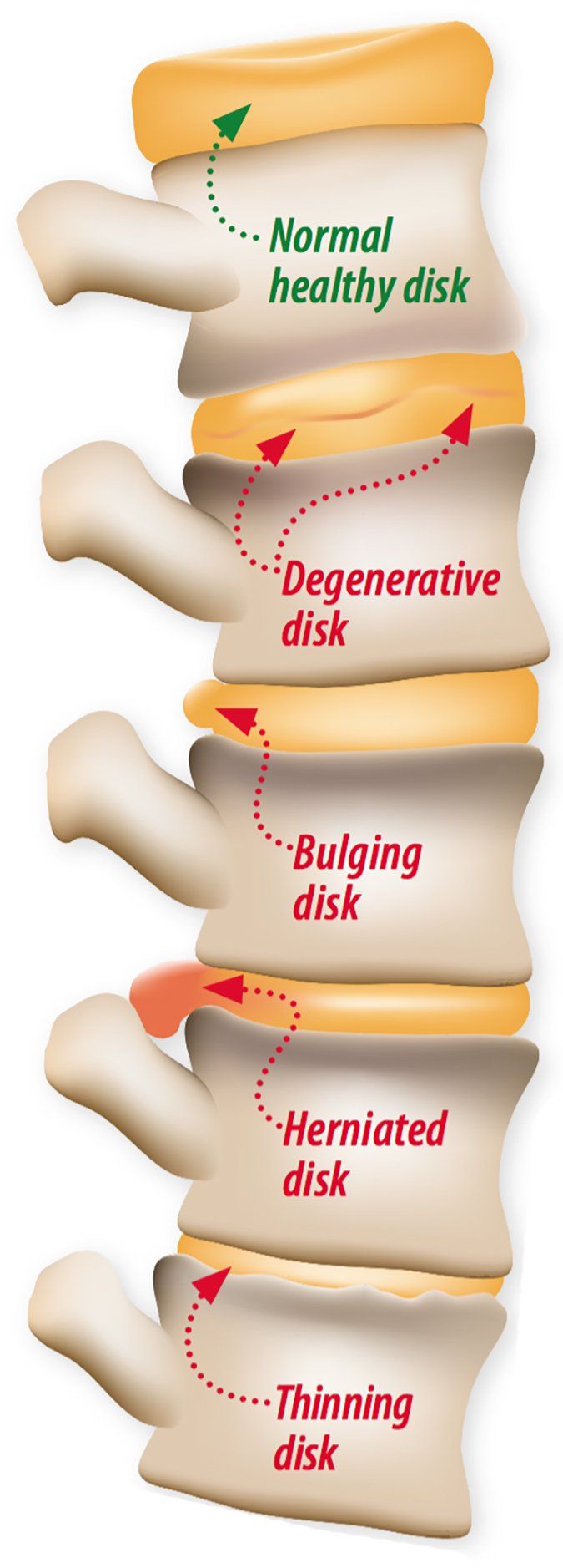 Understanding Degenerative Disk Disease Arthritis Advisor