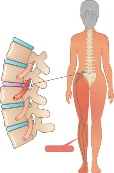 What Is Nerve Pain? - Arthritis Advisor