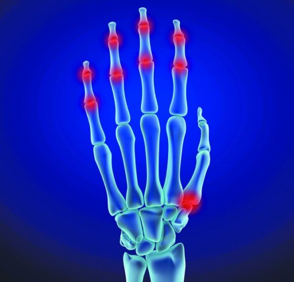 Osteoarthritis In Hands - Arthritis Advisor