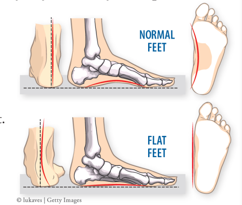 Painful Flat Feet - Arthritis Advisor