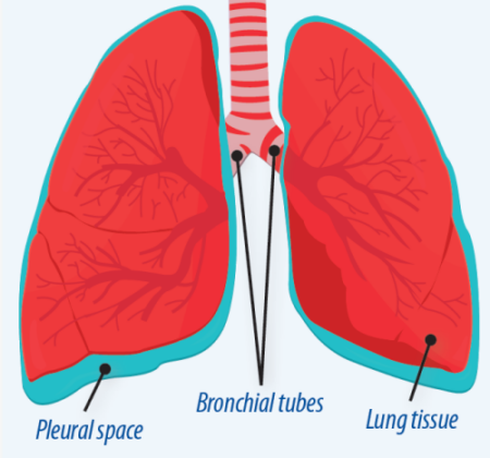 RA and Lung Disease - Arthritis Advisor