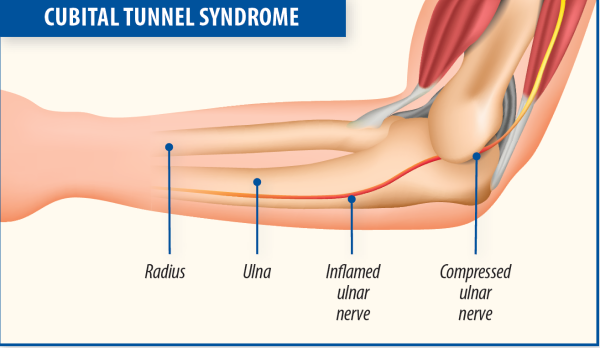 Cubital Tunnel Syndrome - Arthritis Advisor