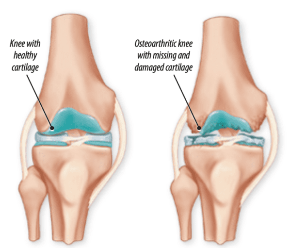 Challenges of Repairing Cartilage - Arthritis Advisor