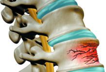 Kyphoplasty for Spinal Fractures