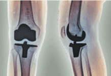 Pain Management After Total Joint Replacement