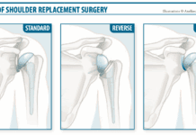 Shoulder Replacement:  Your Type Will Depend on the Health of Your Rotator Cuff
