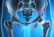 Care for a Broken Hip