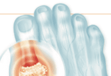 What Is Gout?